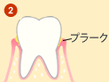 歯周病の進行 流れ2