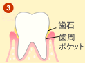 歯周病の進行 流れ3